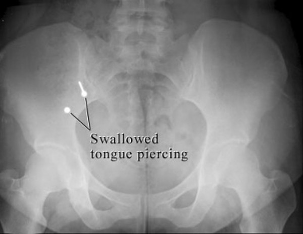 Piercing yang sudah masuk ke daerah tulang pingul Kwikku, Piercing yang sudah masuk ke daerah tulang pingul